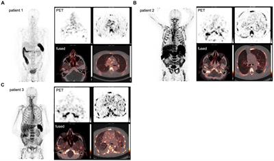 Preliminary evidence of localizing CD8+ T-cell responses in COVID-19 patients with PET imaging